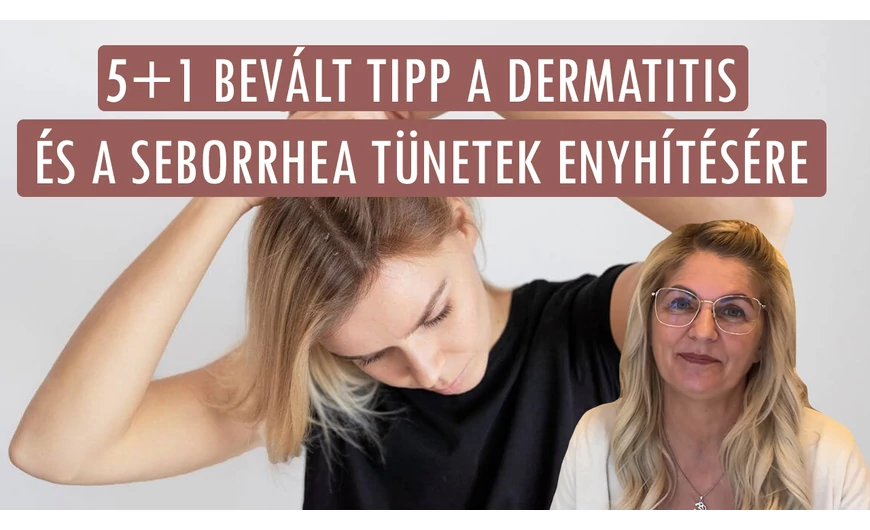 Seborrhea és dermatitis kezelése otthon: 5+1 bevált tipp a tünetek enyhítésére