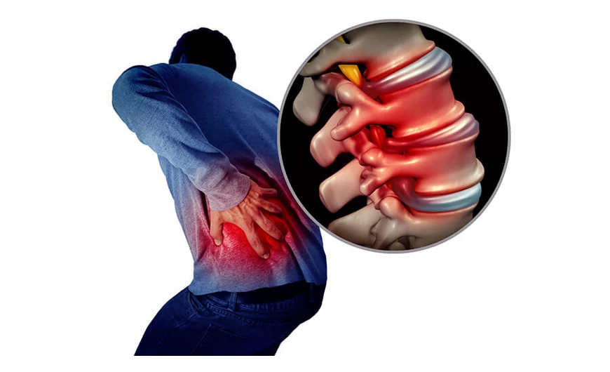 A spondylarthrosis okai, tünetei és kezelése
