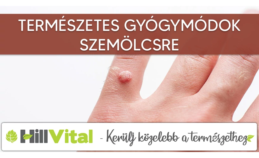 Természetes gyógymódok szemölcsre