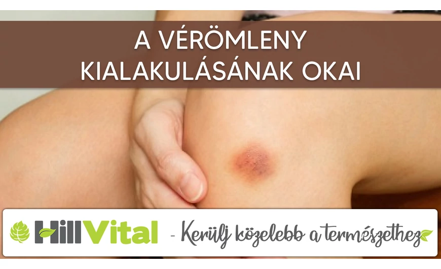 A vérömleny kialakulásának 6 leggyakoribb oka