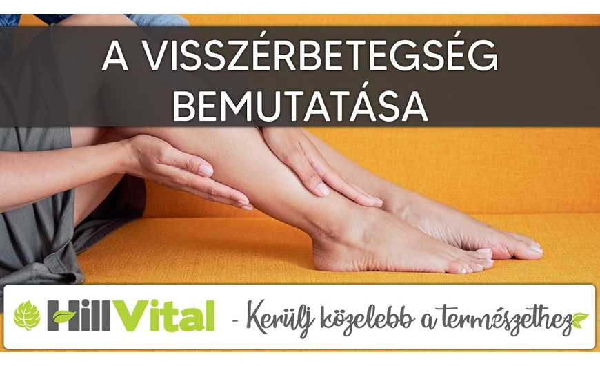 Ezeket kell tudnod a visszérbetegségről! 